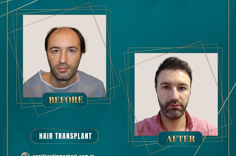 Hair Transplant