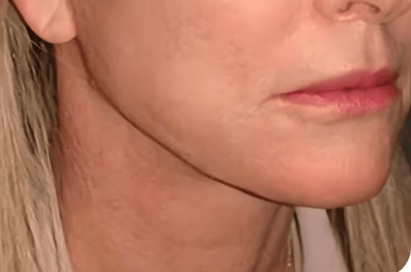 Rhinoplasty Ultrasonic Piezo