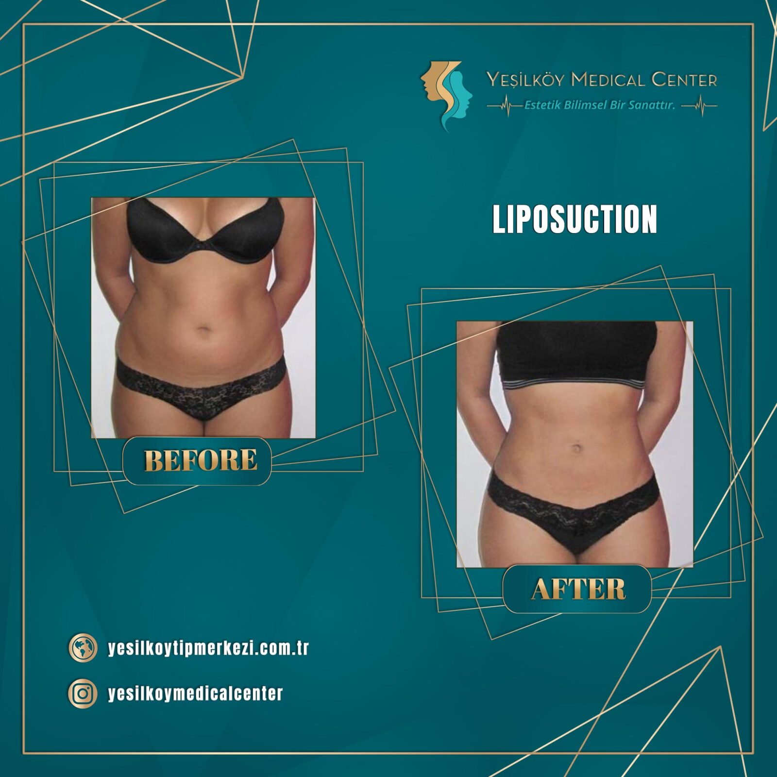 Liposuction hangi durumlarda uygulanır