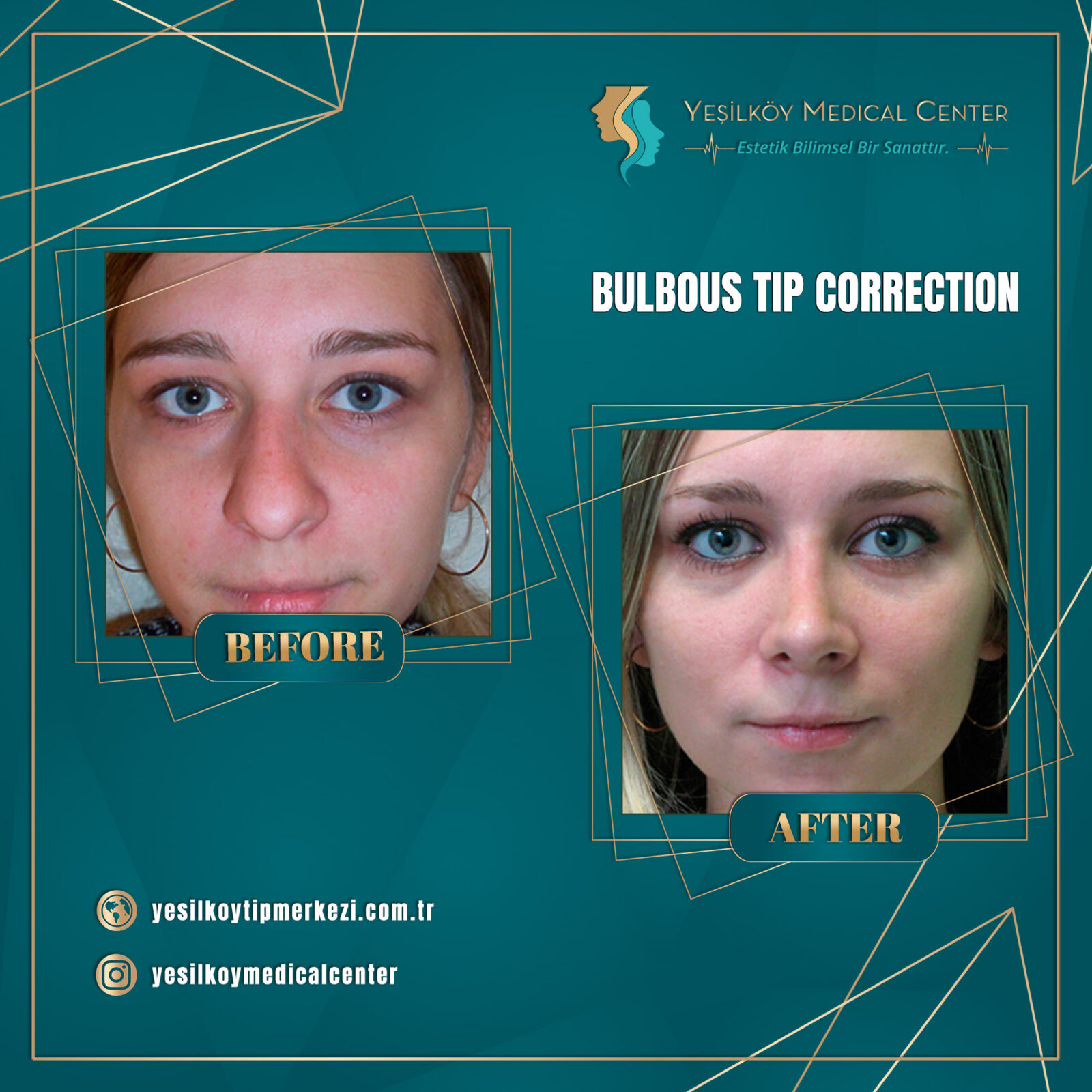 Burun estetiği sonrası iyileşme dönemi